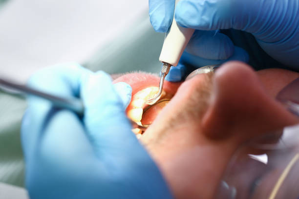 Best Emergency Wisdom Teeth Removal in Evansburg, PA